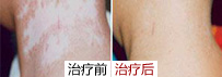 白癜风人群