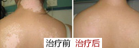 白癜风常识