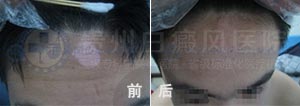 青少年头部局限性白癜风2个月