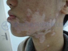 20岁女性面部、颈部白癜风半年