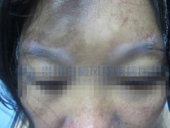 32岁女士双眼眉处白癜风2年,在我院康复