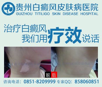 常见的白癜风治疗方法有什么