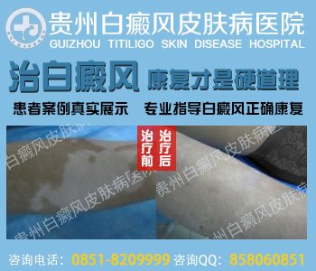 白癜风怎么诊断好