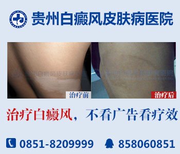 白癜风怎么回事