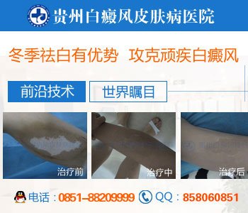贵州白癜风哪里治的好