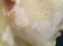 清镇有治白癜风的吗
