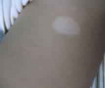 六盘水六盘水哪里有治疗儿童白斑的地方